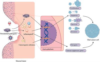 Periodontal Pathogens: A Crucial Link Between Periodontal Diseases and Oral Cancer